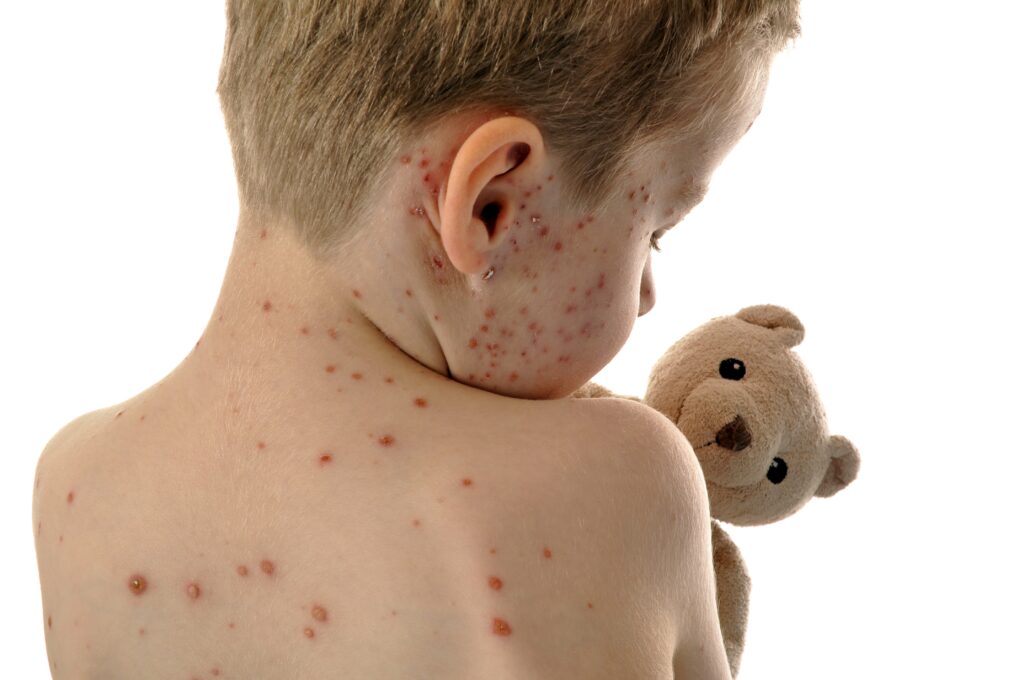Texas Measles Outbreak Grows To 327