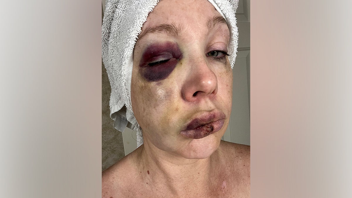 The battered and bruised face of Cincinnati beating victim, known only as Holly