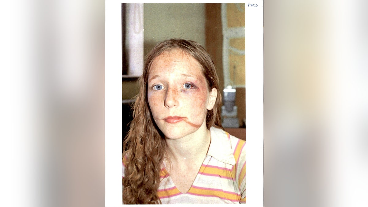 Norma Countryman showing her injuries caused by Warren Forrest.