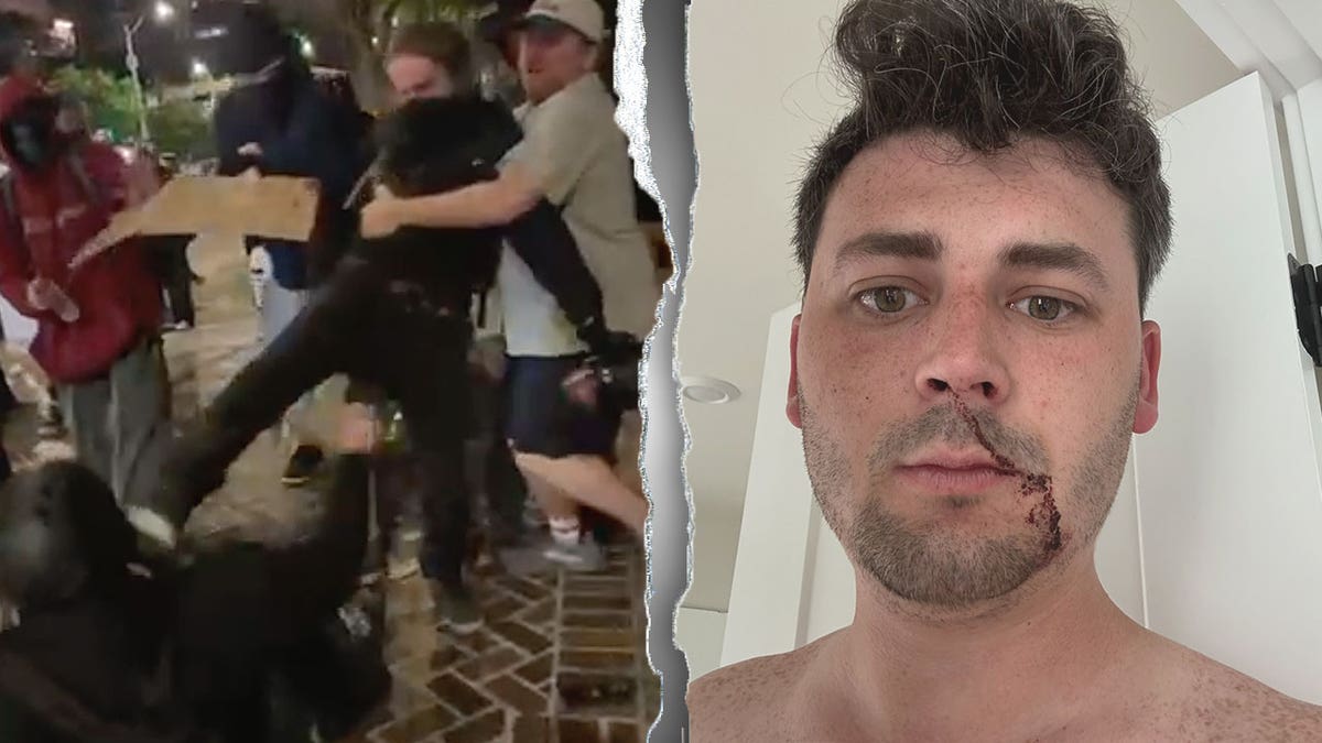 Cameron Higby showing beat up face after assault